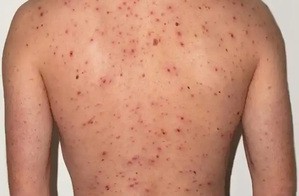 شیوع آبله مرغی در پنجشیر با 82 مبتلا