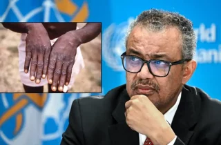 فراخوان سازمان صحت جهانی برای اقدام فوری جهت مهار شیوع آبله میمون در آفریقا