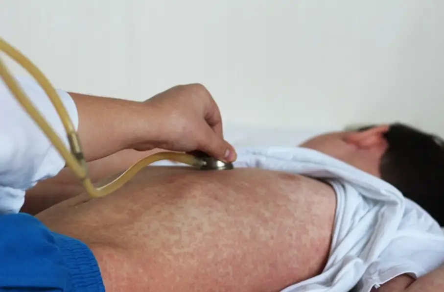 افزایش مرگومیر ناشی از سرخکان در افغانستان؛ پزشکان بدون مرز: روزانه یک کودک جان میبازد