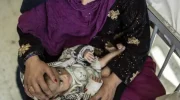 افزایش مرگ‌و‌میر کودکان به دلیل سوء تغذیه در ننگرهار