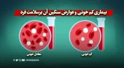 بیماری کم خونی و عوارض سنگین آن برسلامت فرد